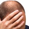 Kopaszodással, foltos hajhullással küzd?